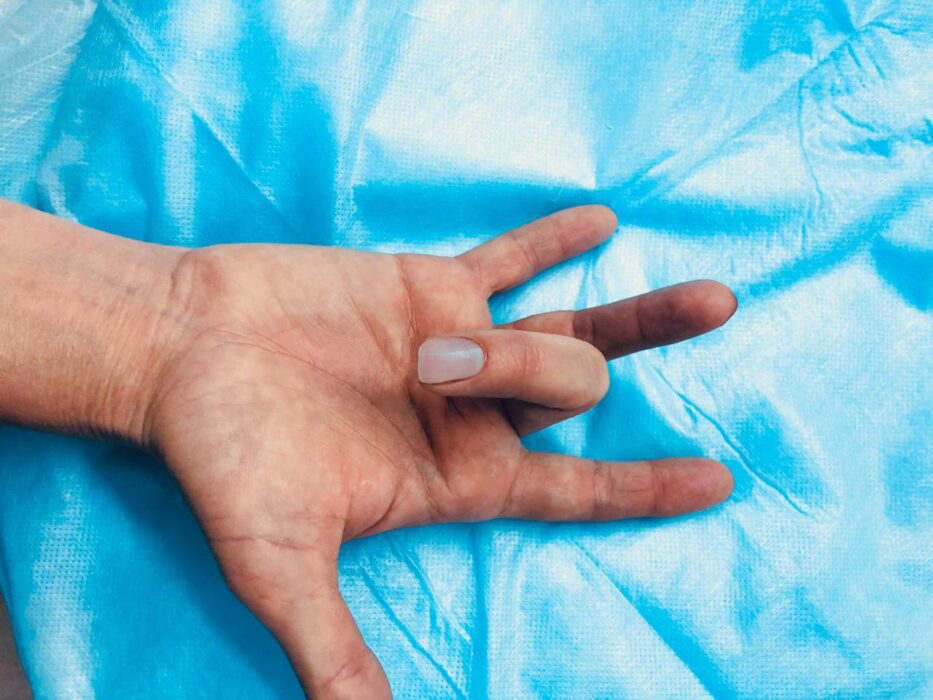 Оренбургские травматологи выполнили сложную операцию на кисти руки